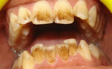 Does Mint Tea Stain Teeth: Exploring the Intricacies of Tea Staining and Mouth Freshness